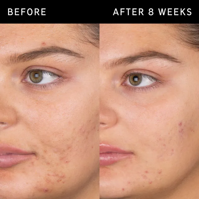 Salicylic Acid Cleanser – image 2